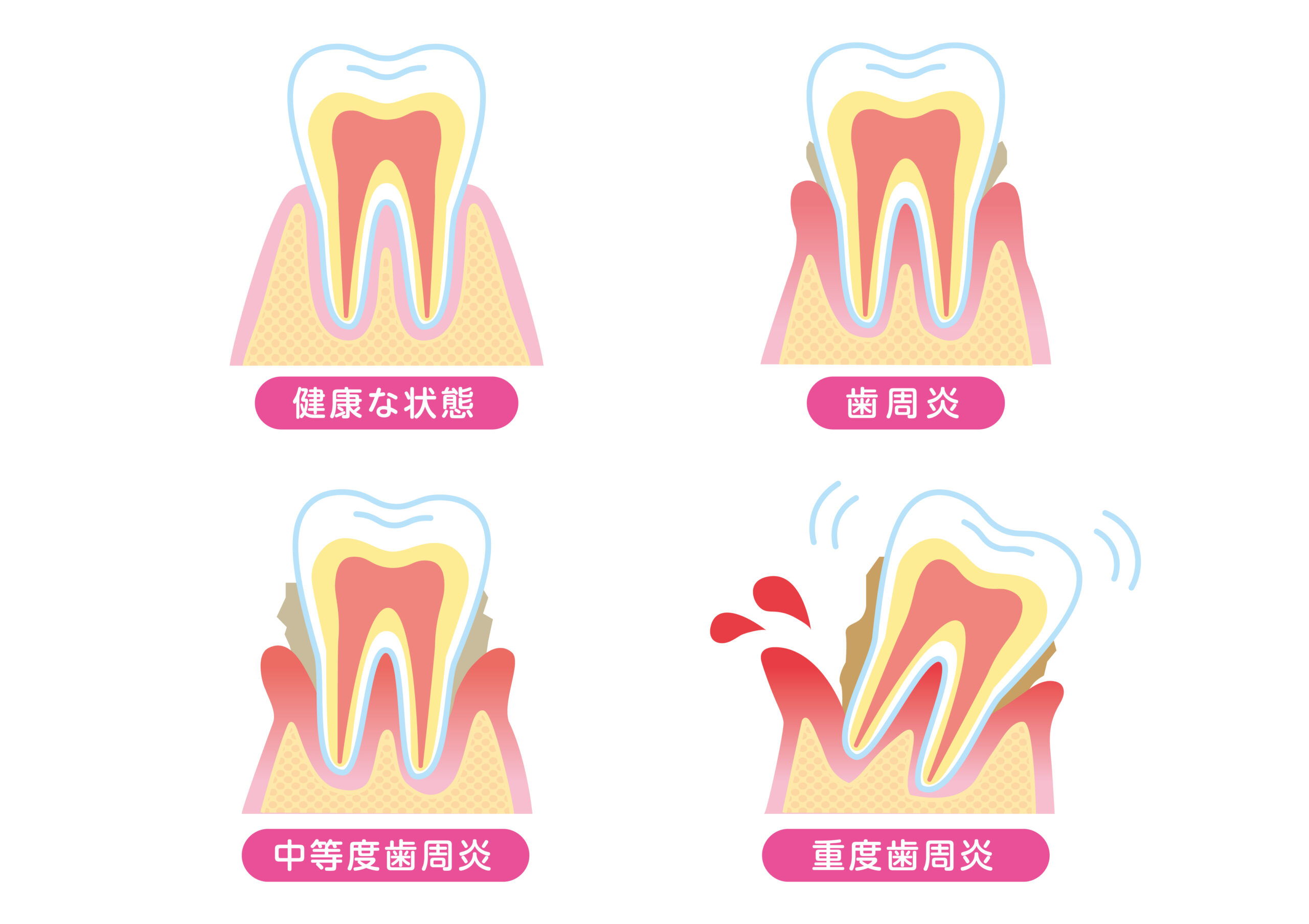歯が浮くようなの意味と語源に驚愕！医学の真相と正しい使い方