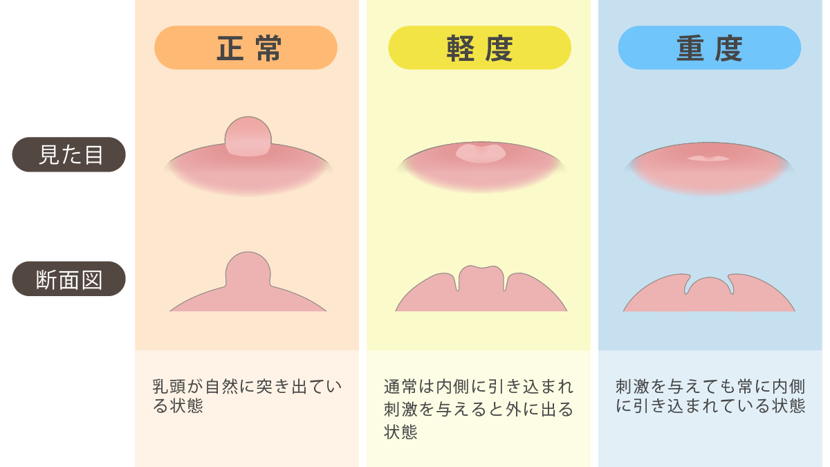 陥没乳頭の原因は生まれつきだけじゃない？病気リスクと治し方の真相