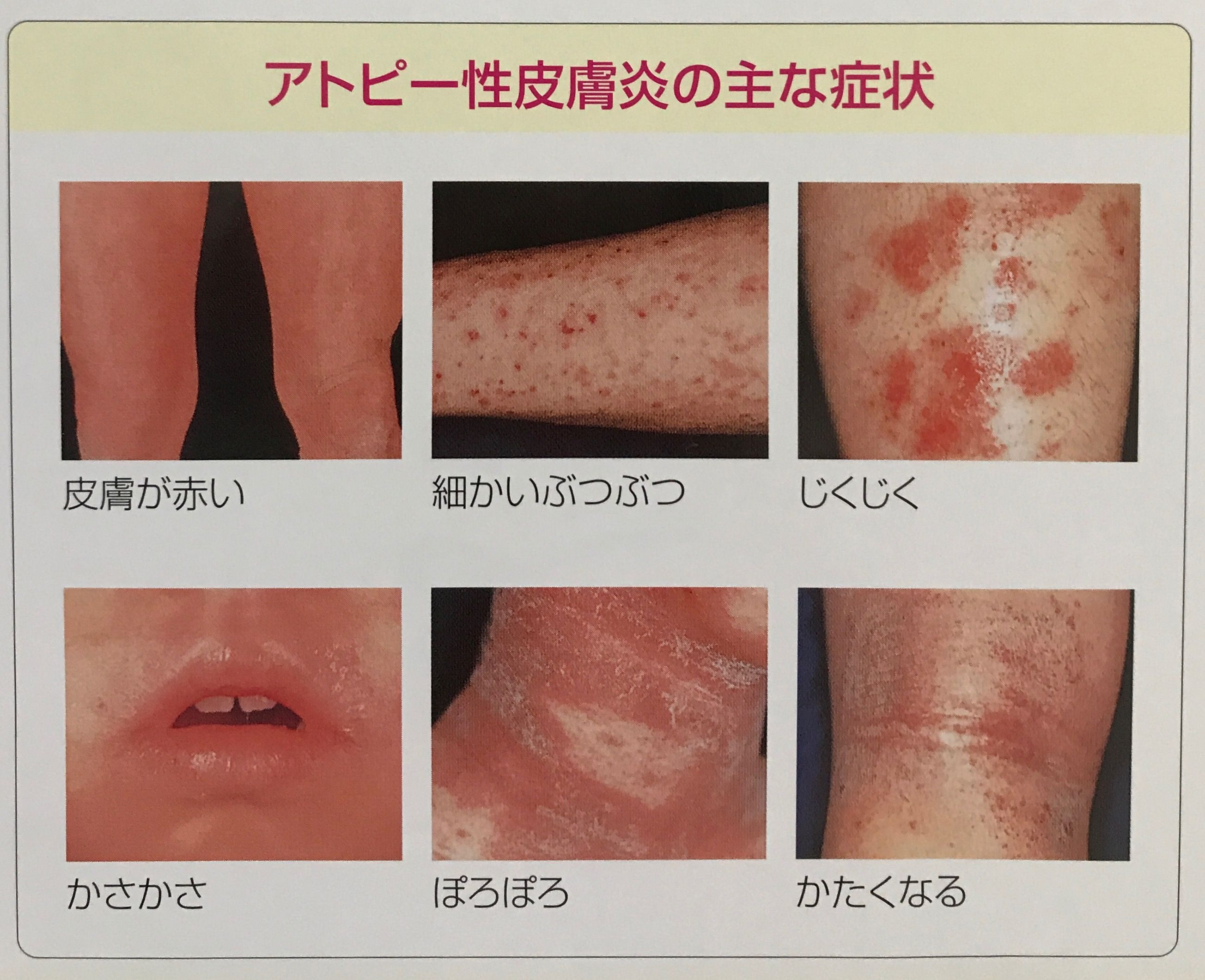 アトピー治る過程の時系列変化と回復サイン｜皮膚再生までの全貌