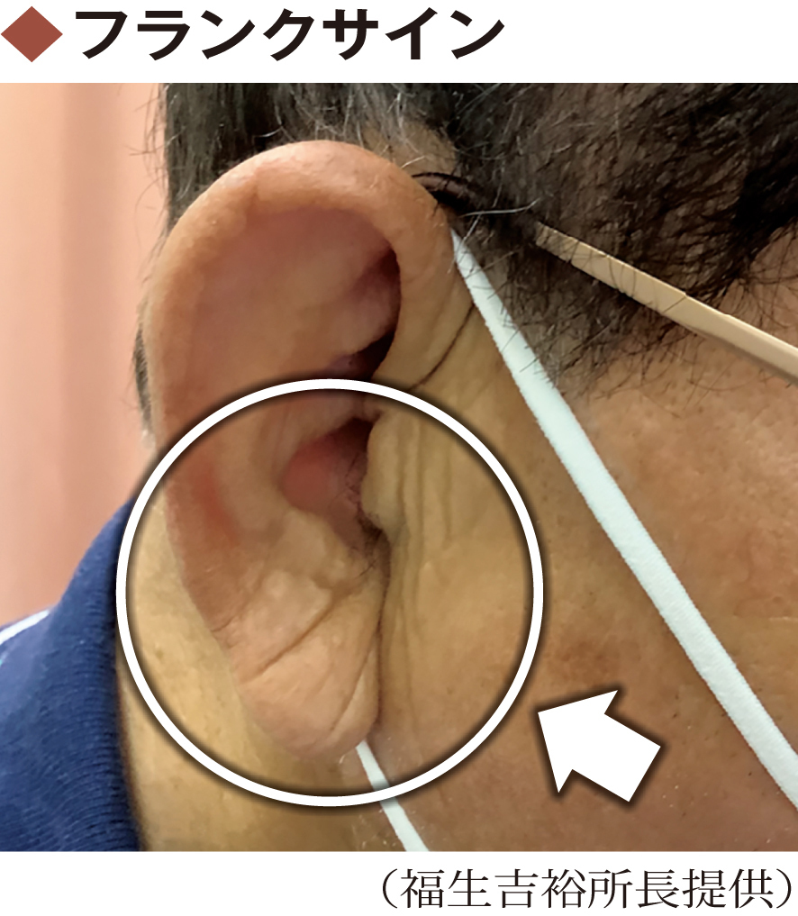耳たぶの斜めじわは動脈硬化の予兆？フランク徴候の見分け方と危険度
