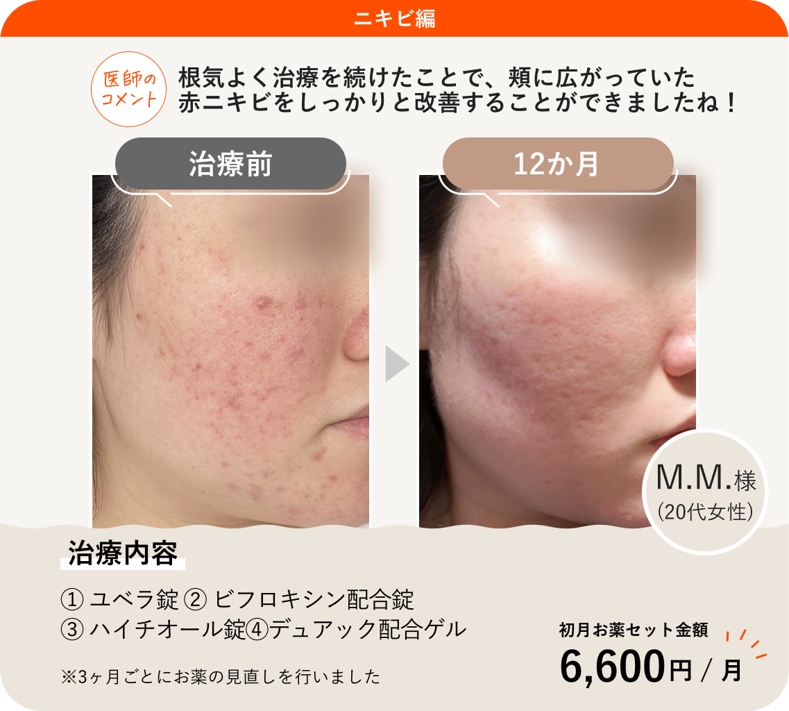 痛い赤ニキビの治し方完全版！潰すのはNg？跡を残さず鎮静させる秘訣