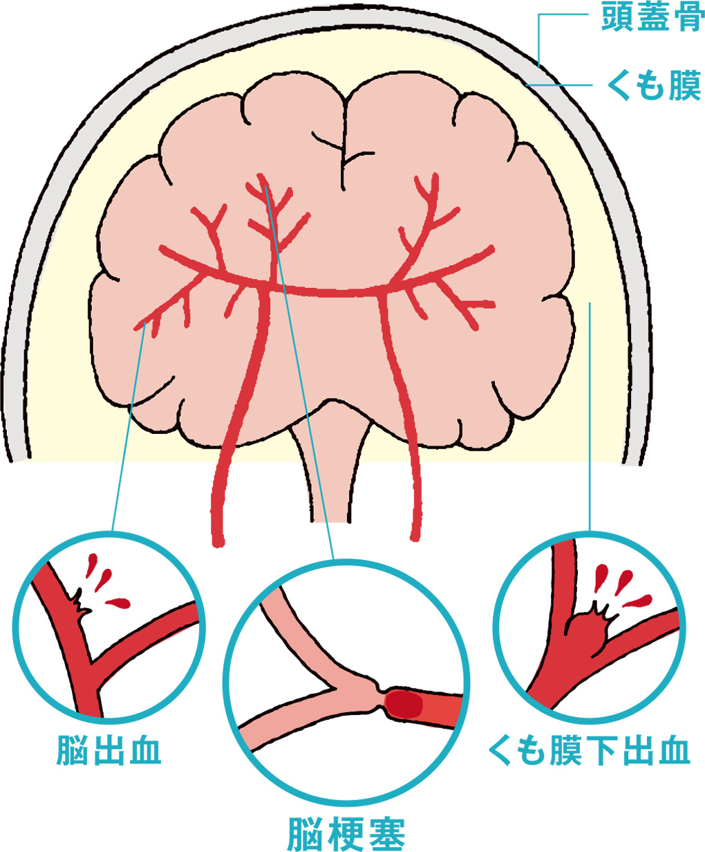 隠れ脳梗塞と言われたらどうすべき？放置リスクと受診科・最新予防策
