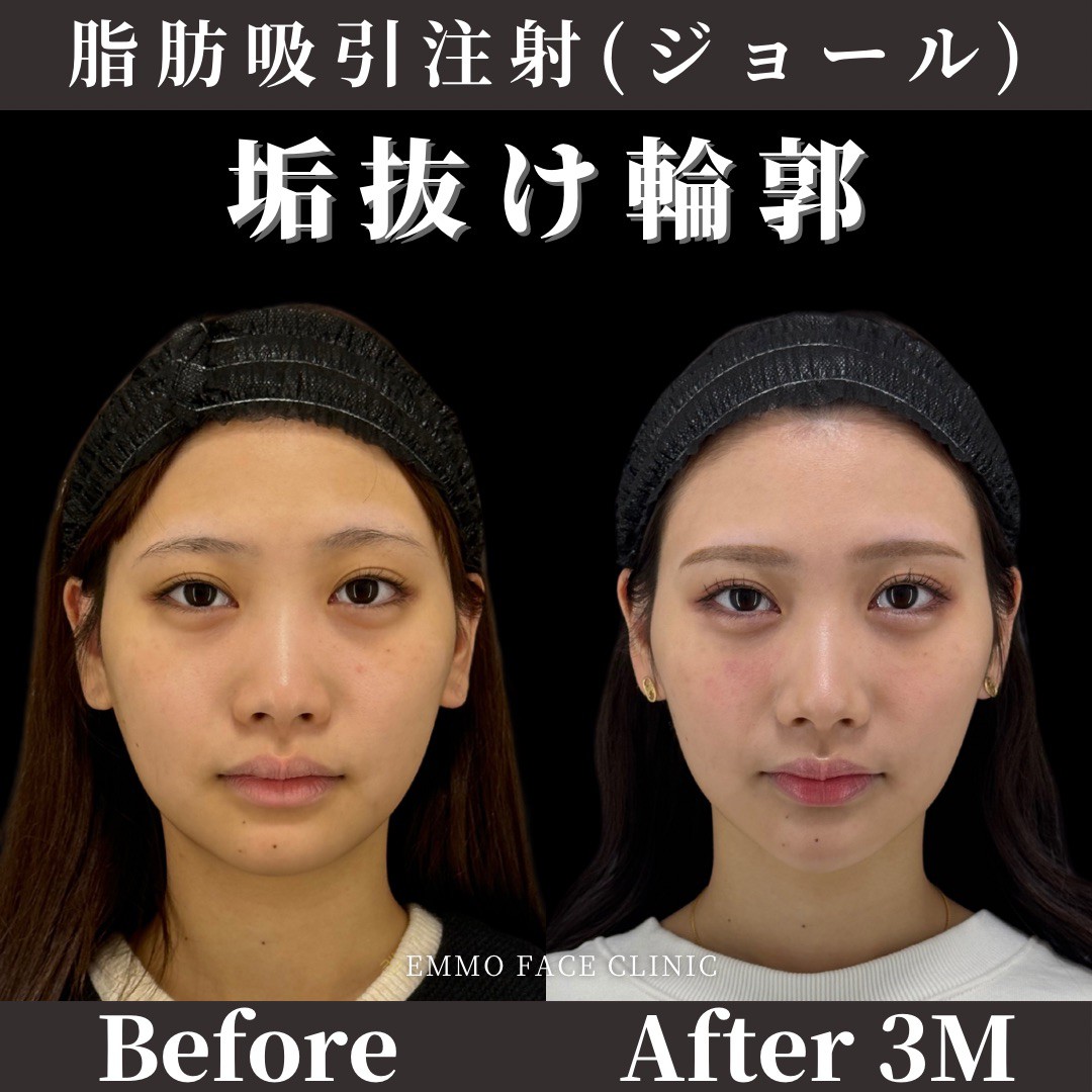 顔の肉が落ちない原因とは？2026年最新の即効解消法とプロの結論
