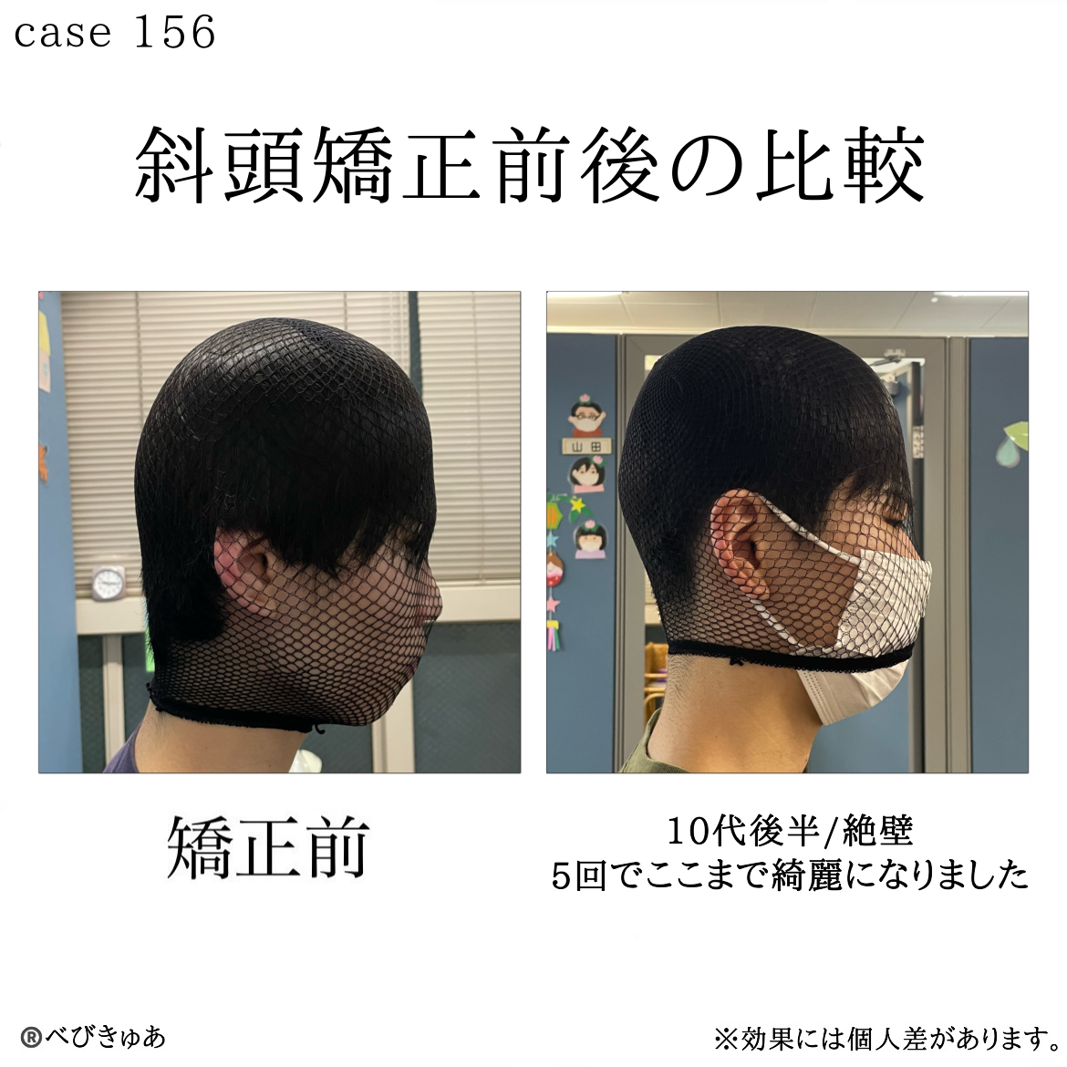 大人の絶壁頭は克服できる！後頭部を救う最新骨格補正メソッド