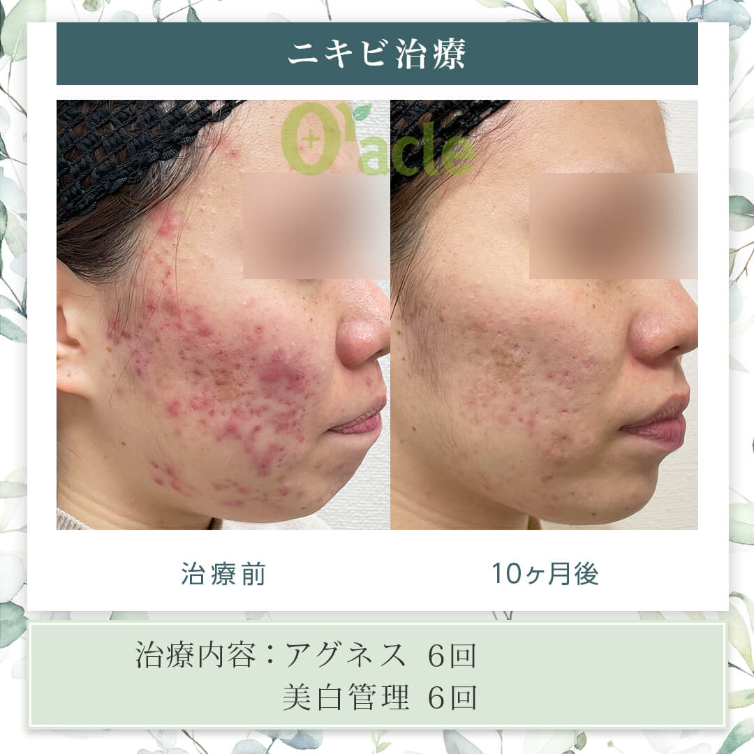 マスクでニキビが悪化する原因とは？皮膚科医直伝の治し方と最新予防策