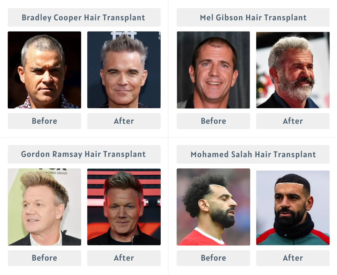 Celebs Who Have Had Hair Transplants