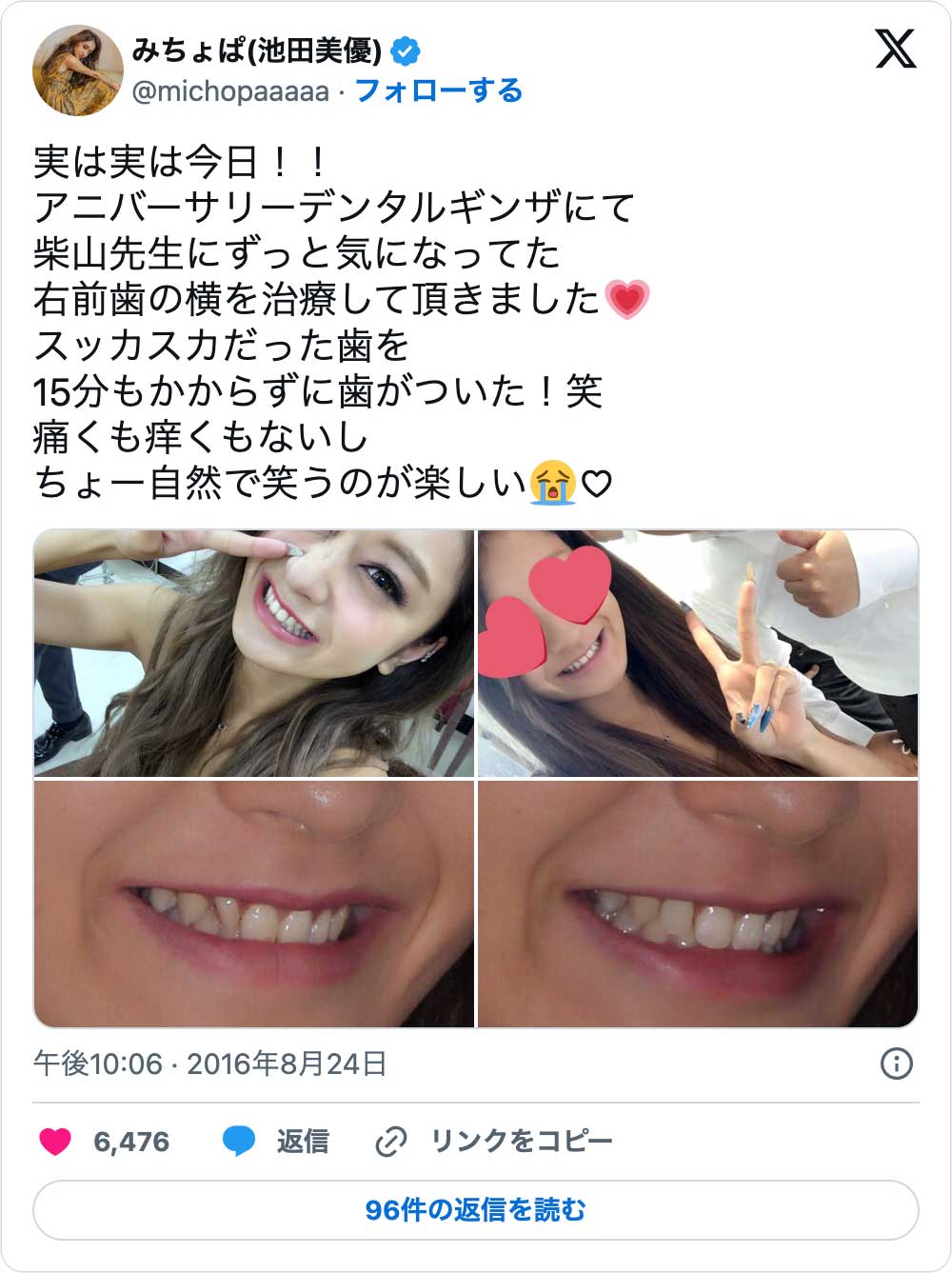 芸能人の歯はなぜ白い？セラミック治療の費用と後悔・不自然な真相