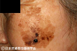 【2026最新】 顔 が 黒い 病気 画像 気になる噂と真相 #903