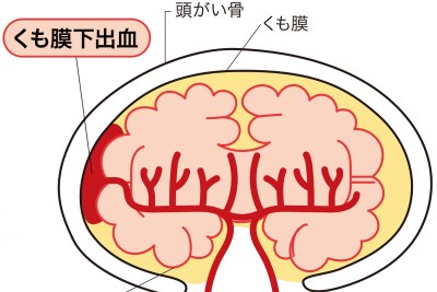 【Wiki風】 星野 源 くも膜 下 出血 インスタライブ最新動画 #988