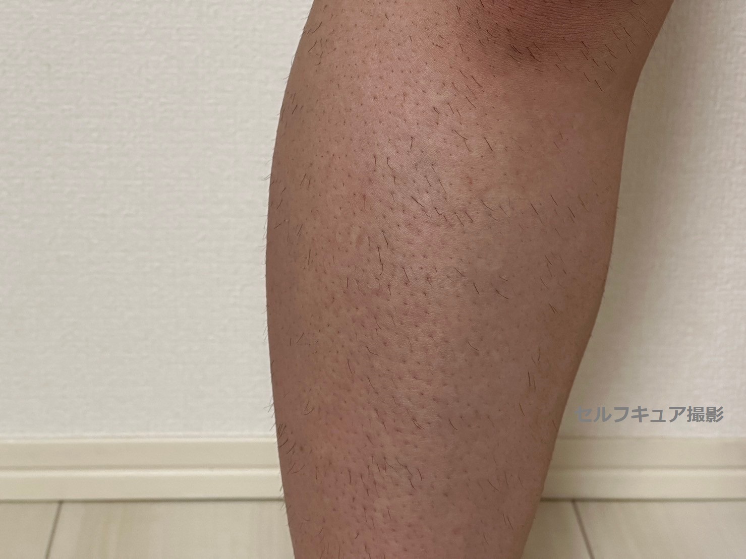 チョコザップ脱毛の効果は何回で実感？ヒゲ・Vioの真相と評判を徹底検証