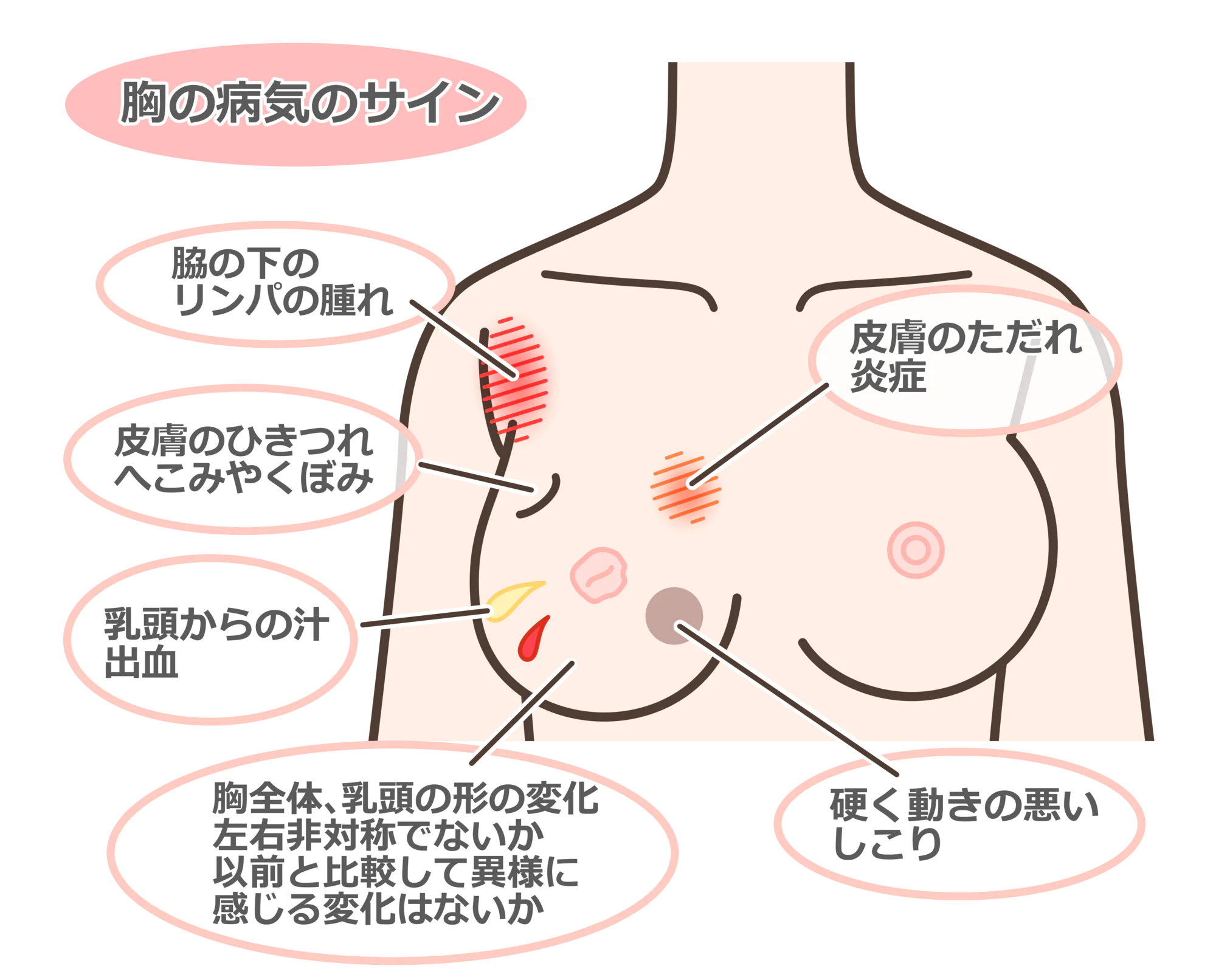 乳がんのひきつれ画像と初期サイン｜胸のくぼみ・えくぼ徴候の真実