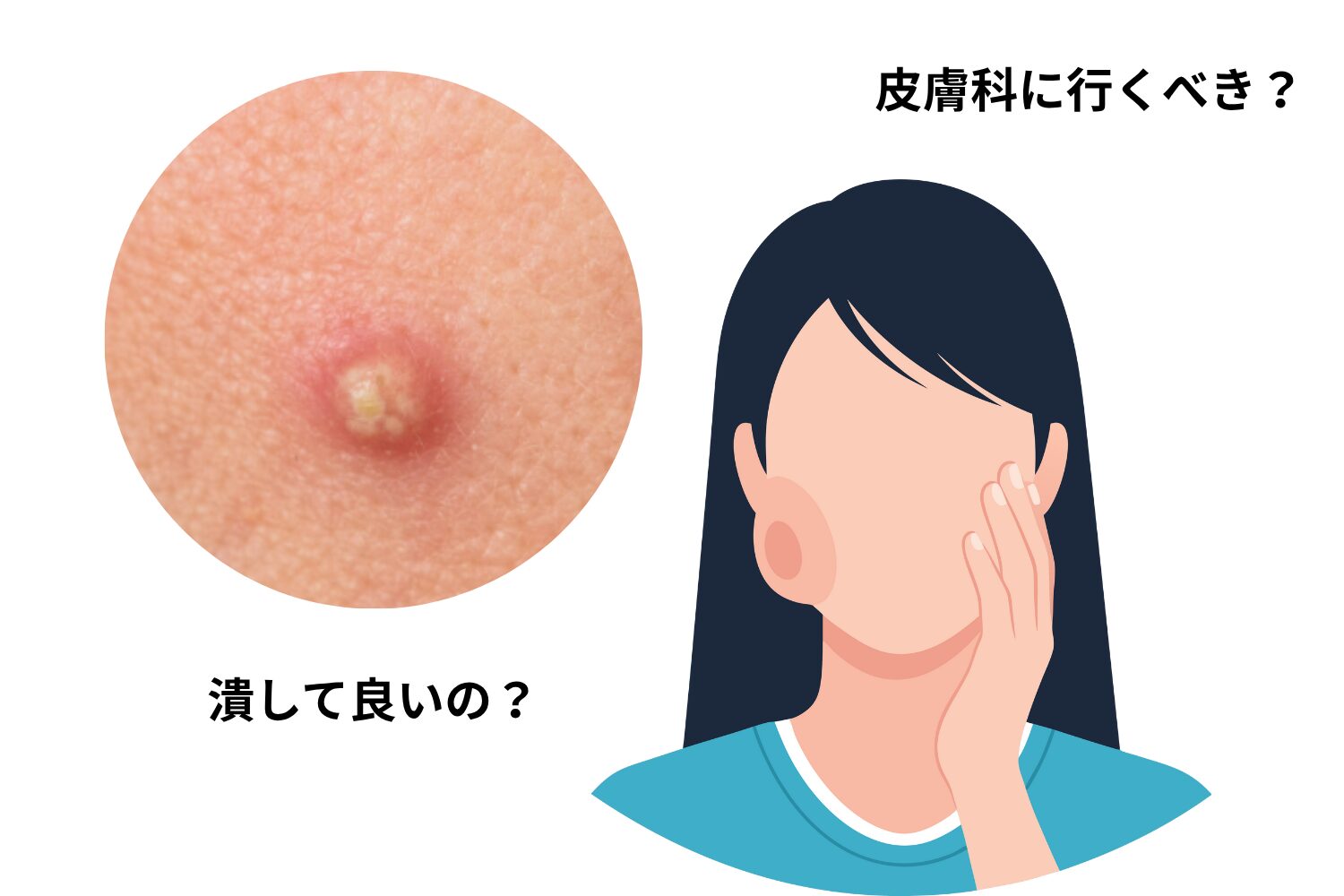 ニキビの膿は出すべき？クレーター化防ぐ最新皮膚科治療と正しい対処法