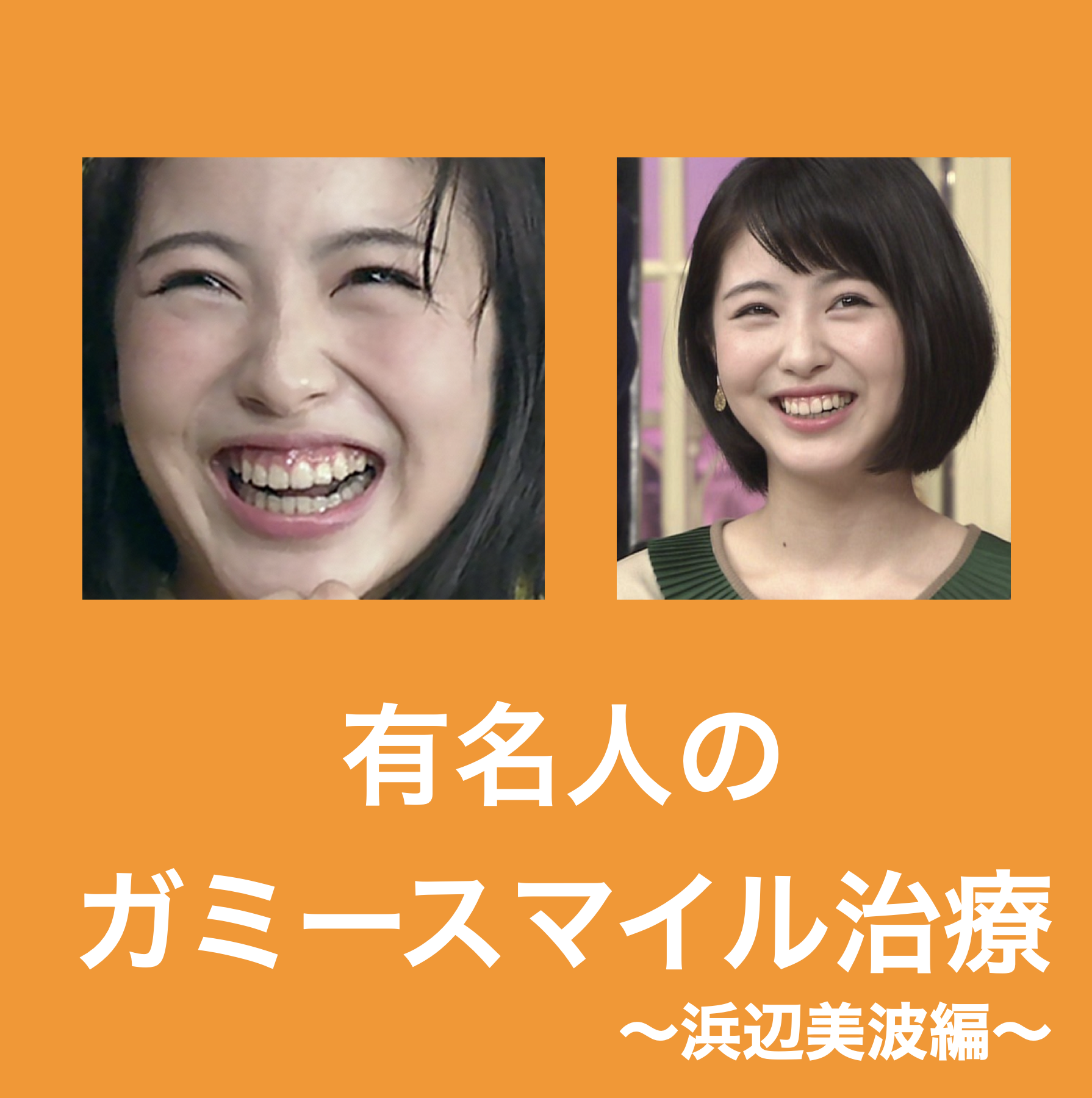 浜辺美波の歯並び矯正を徹底検証！八重歯消失の真相と口元の変化