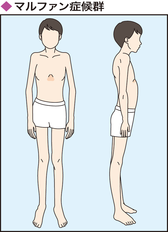 アンガールズとマルファン症候群の噂の真相！病気疑惑と現在の健康状態