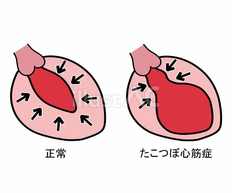 【2026年医療報告】突然の激痛、心筋梗塞と誤認される「心臓変形」の真実——激増するストレス社会と「たこつぼ心筋症」の最新知見