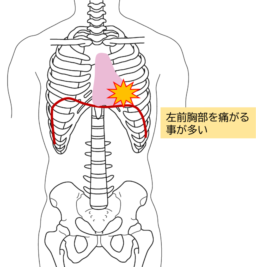 息を吸うと胸が激痛？前胸部キャッチ症候群の原因と見分け方を解説