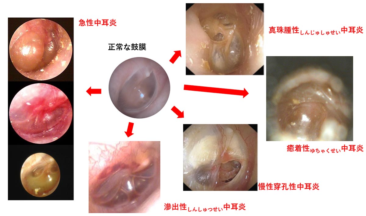 耳から血が出るのはストレスが原因？危険な兆候と受診目安を徹底解説
