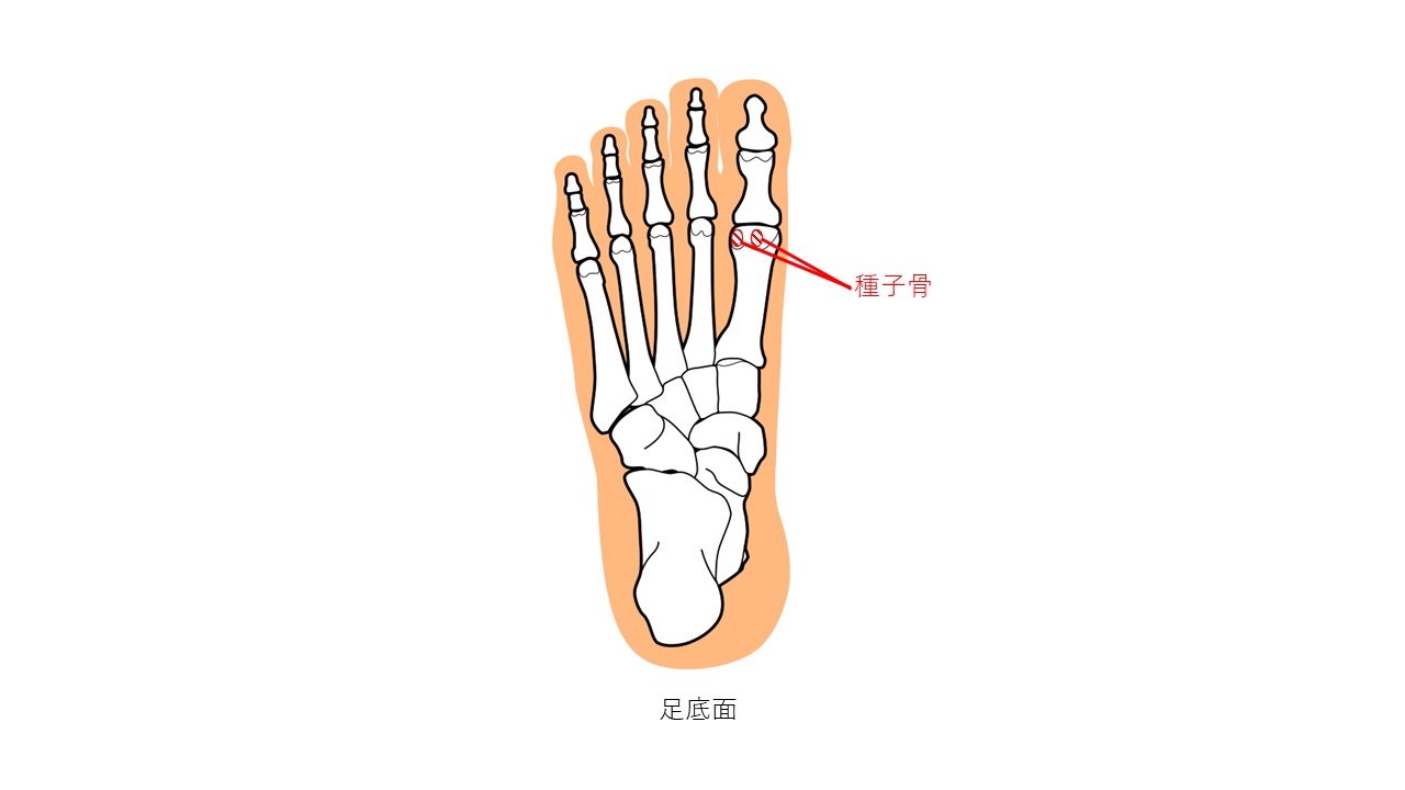 母趾球の激痛「種子骨炎」が治らない理由と早期回復への完全ガイド