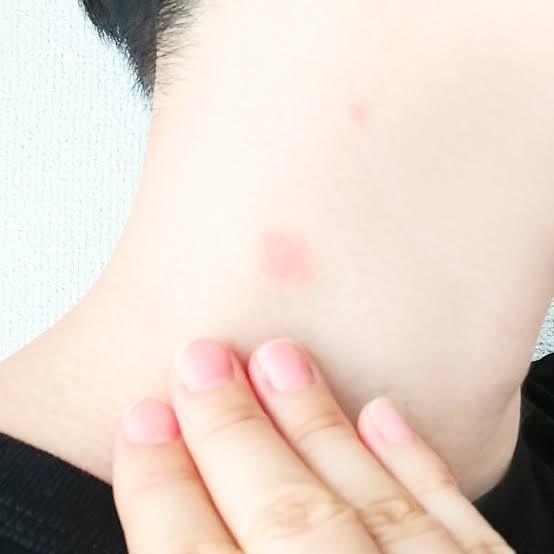 O型は本当に蚊に刺されやすいのか？科学が暴いた真相と最新対策法
