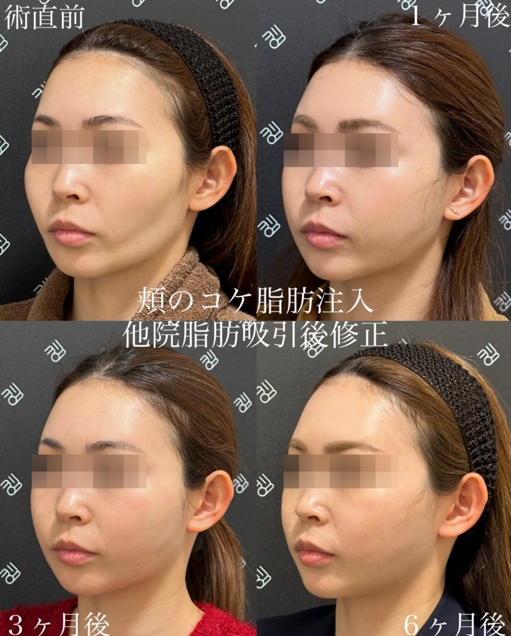 急な頬のこけはなぜ起きる？老け見え原因と失敗しない改善法