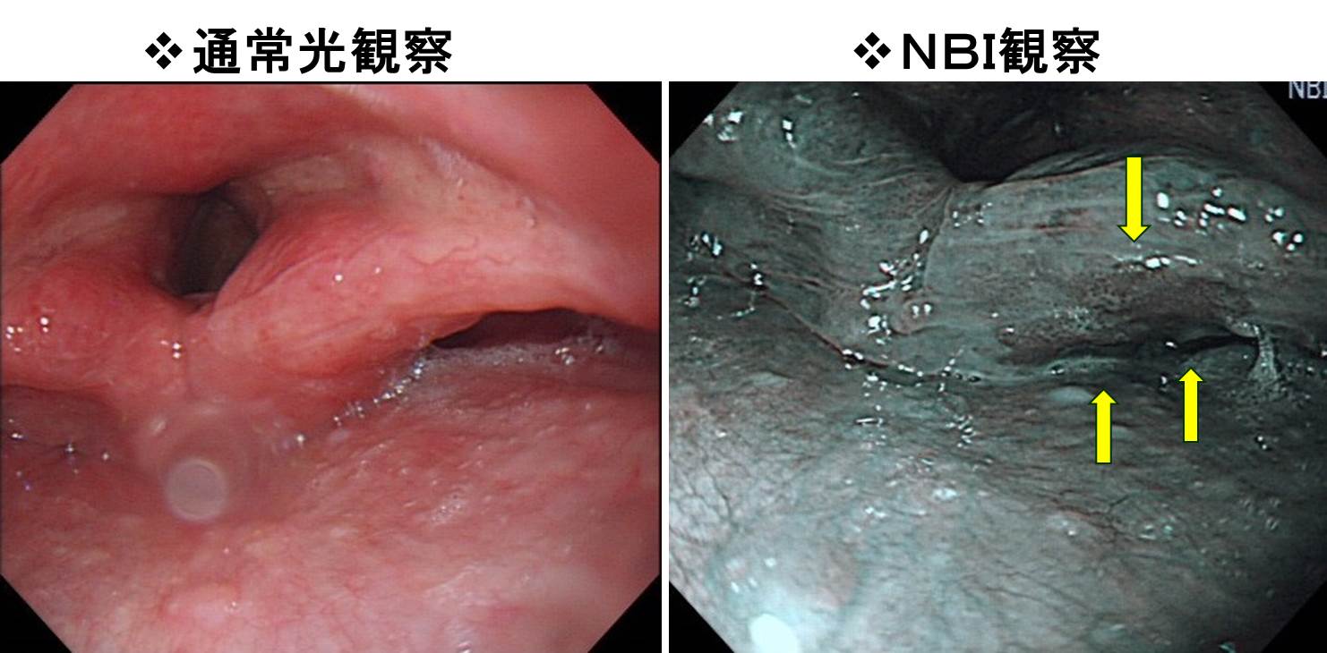 お酒で顔が赤くなるのはなぜ？Aldh2遺伝子の真実と食道がんリスク