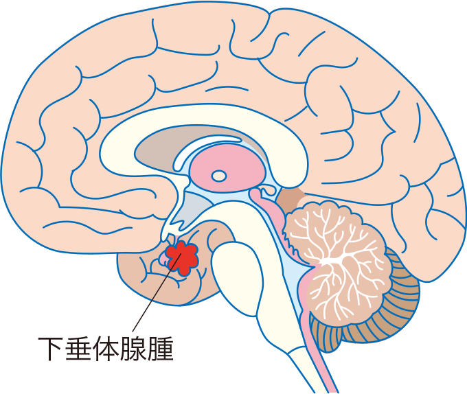 ガンバレルーヤよしこが投じた一石——下垂体腺腫の克服から考える「顔の変化」と早期発見の重要性