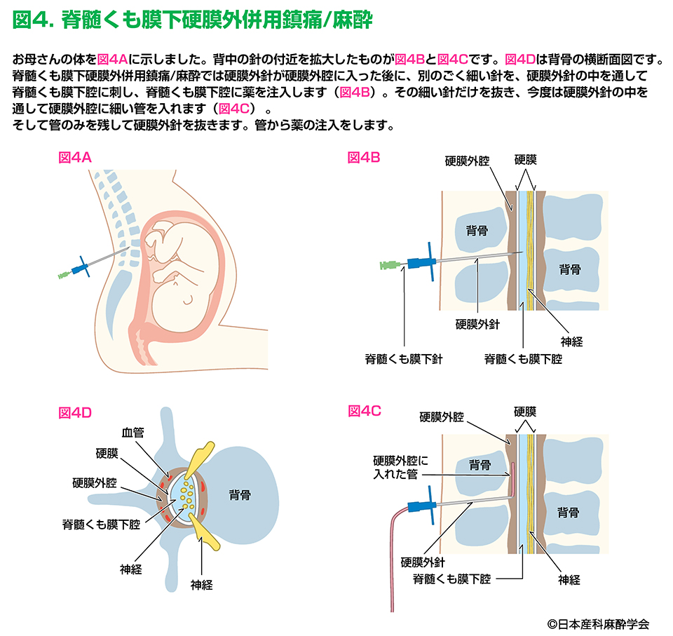 麻酔の後遺症はなぜ残る？しびれや吐き気の原因と危険な兆候を徹底解説