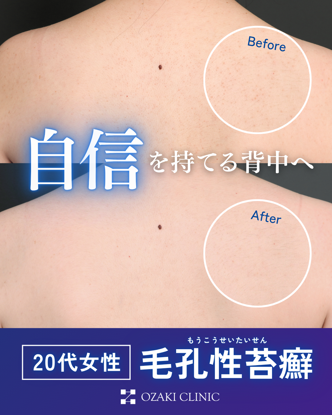 二の腕のブツブツは治る？毛孔性苔癬治療の保険適用と最新レーザーの実力