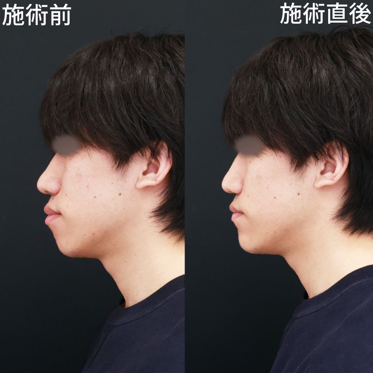 口ゴボに悩む男性の真実｜原因と改善法・女性の本音まで徹底検証
