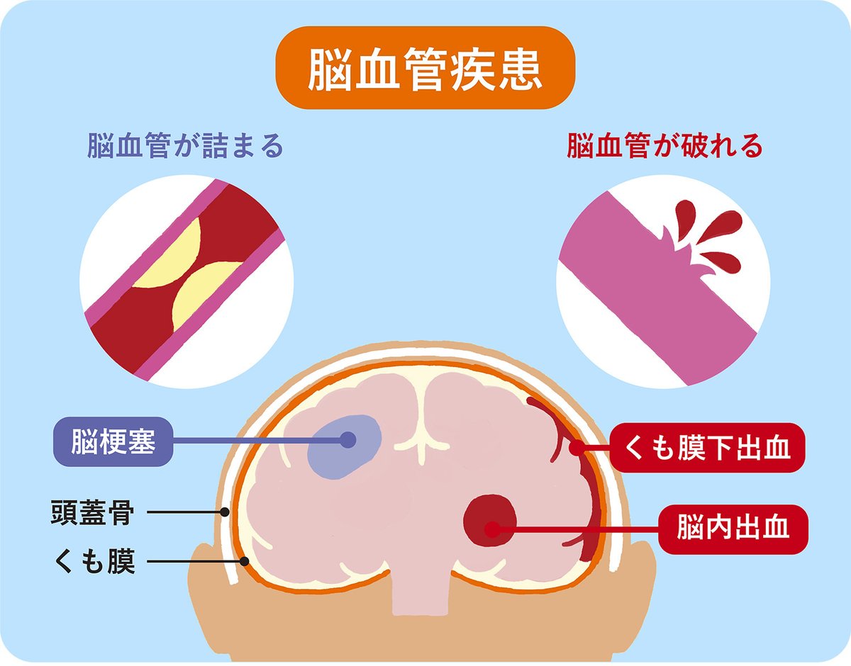 脳疾患とは？命に関わる前兆サインと種類一覧｜最新チェック法【2026】