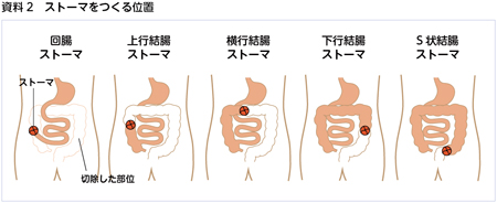 「生きるための選択」を隠さない時代へ。人工肛門（ストーマ）を公表した著名人たちが変える社会の偏見と、2026年のリアル