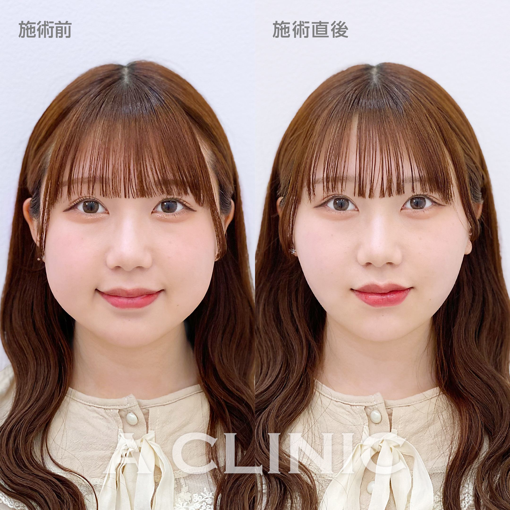 なぜあの人は小顔なのか？骨格差を覆す2026年最新メソッド総まとめ