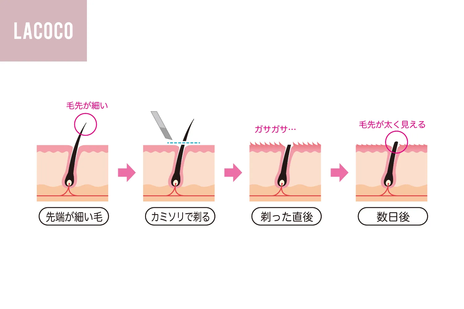 「毛を剃ると濃くなる」は嘘？皮膚科医が暴く真相と正しいムダ毛ケア
