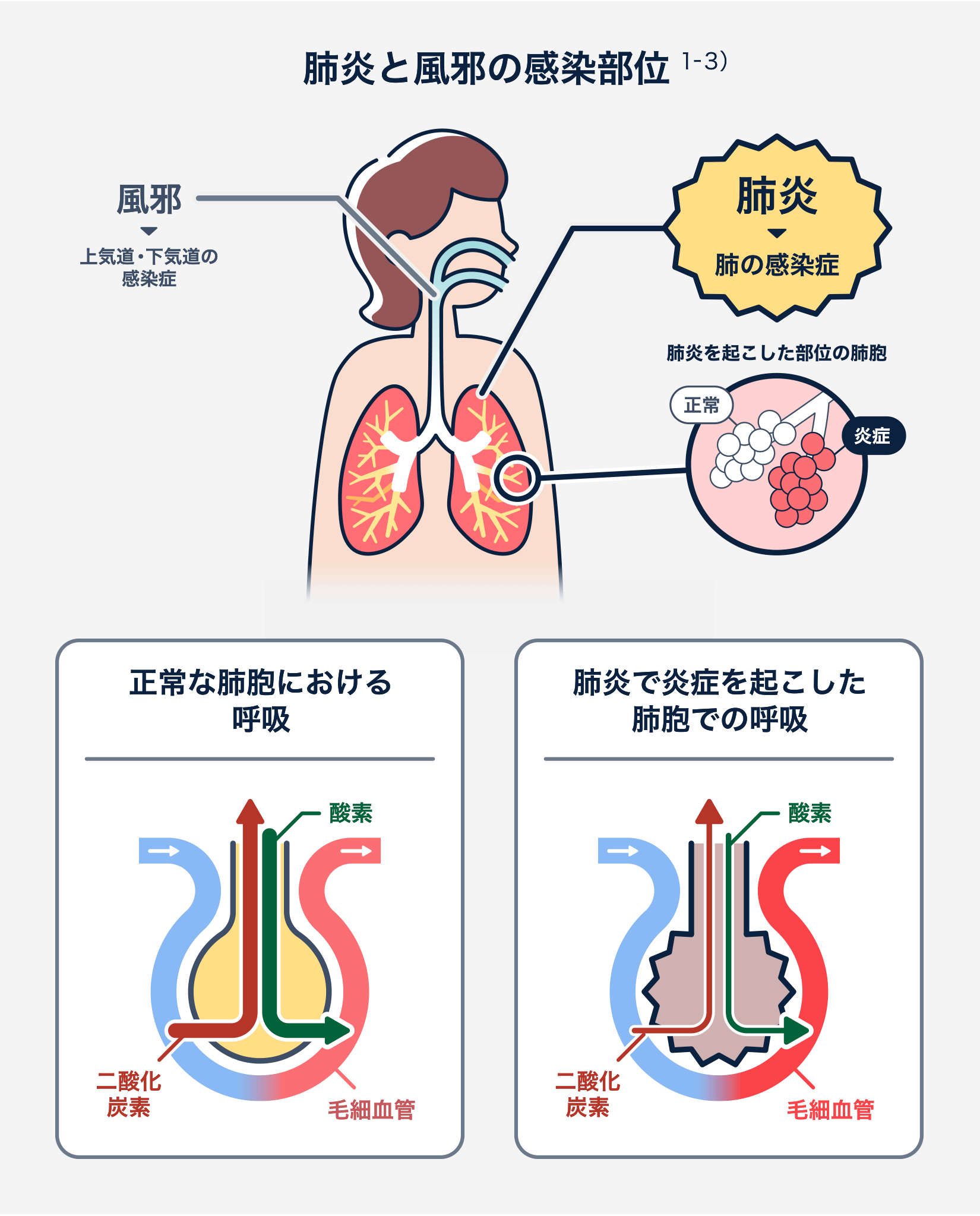 新型肺炎の症状と風邪の違いは？2026年最新の初期兆候と受診目安