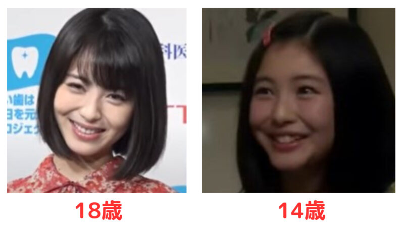 浜辺美波の歯並び変化と矯正の真相｜八重歯消失の時期や手法を徹底検証