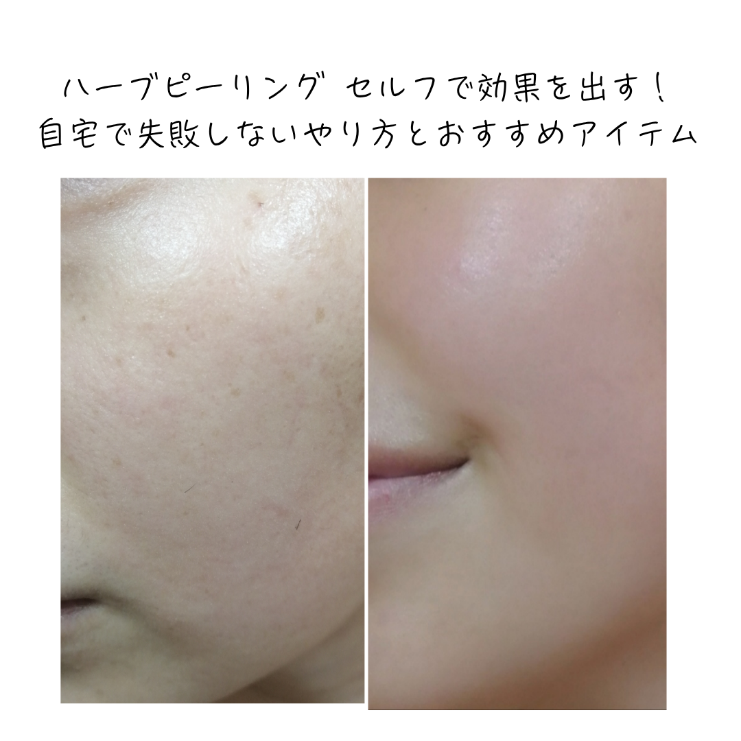 セルフハーブピーリングの真実｜サロン級美肌の嘘と失敗リスク