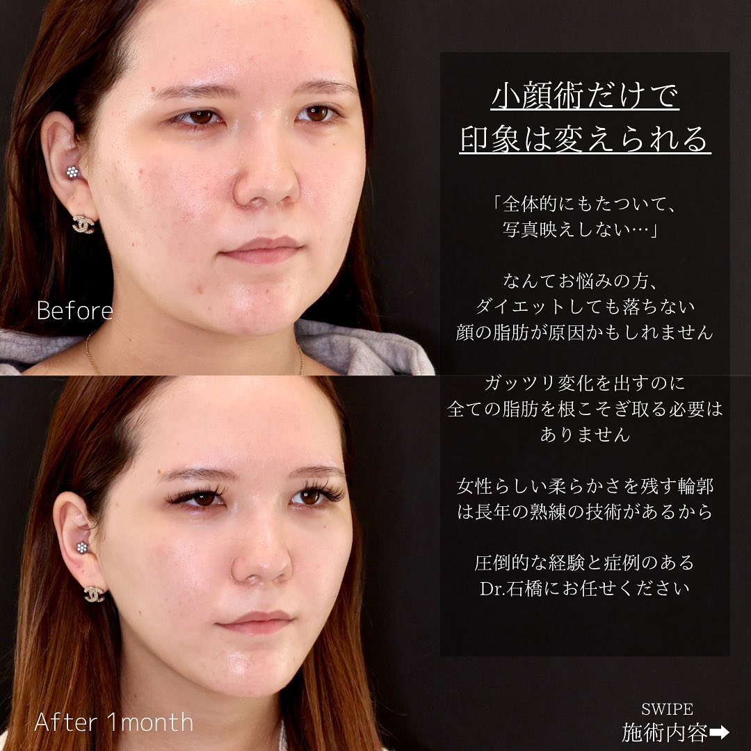 1週間で顔の肉を落とす！むくみと脂肪を最速撃退する小顔メソッド