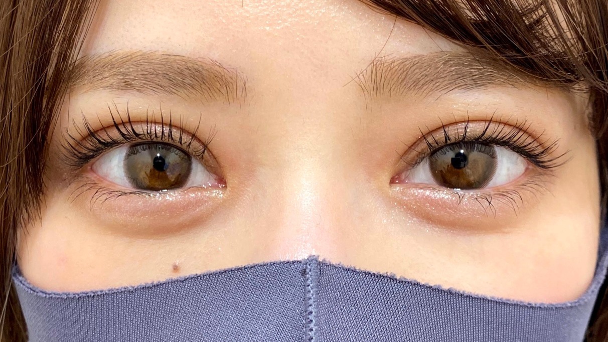 二重幅が広すぎて変なのはなぜ？ハム目と腫れの見分け方と修正の真相