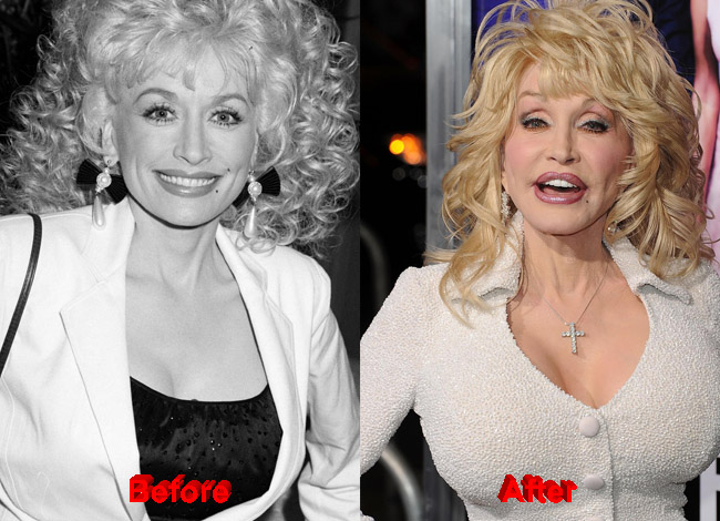 Breast Lift at 40: Dolly's First Confirmed Procedure Before Implants