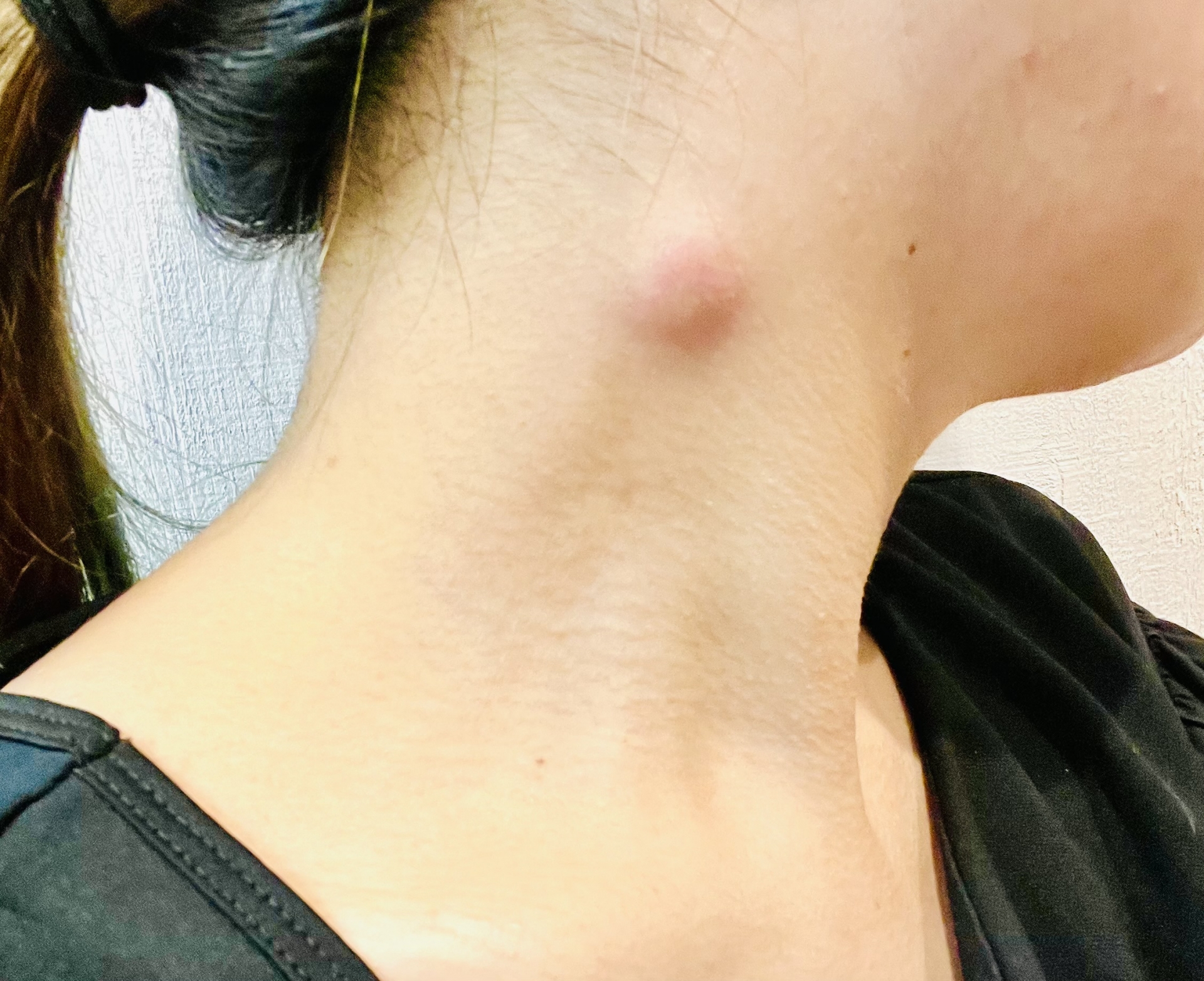 粉瘤が再発する原因とは？袋の取り残しと再手術の費用・術式を徹底解説