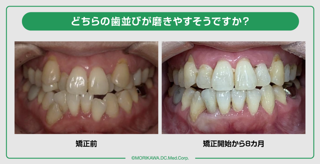 歯並びを自力で治すのは可能？専門医が警鐘を鳴らす自力矯正の真実