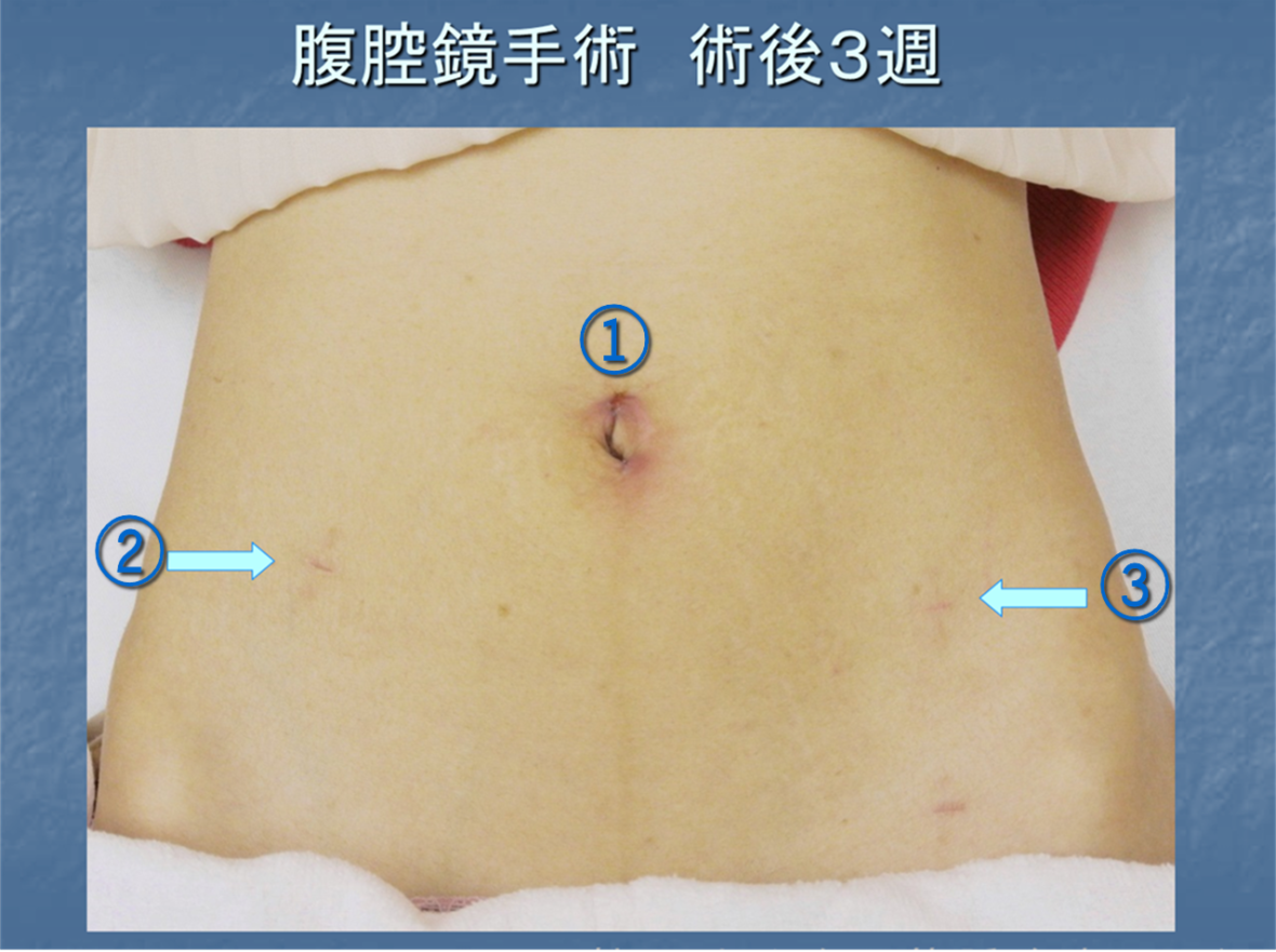 腹腔鏡手術の術後はいつまで痛む？痛みのピークと仕事復帰のリアル