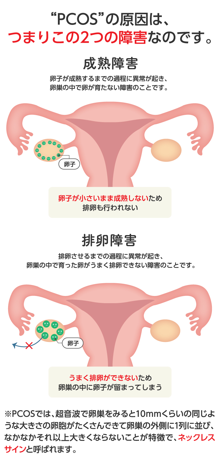 多嚢胞性卵巣症候群の治療法と真実｜自力改善や妊娠への道筋を徹底検証
