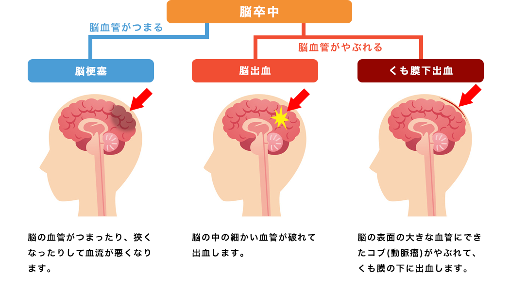 脳卒中と脳梗塞の違いとは？危険度の真相と命を救う前兆サイン【最新】