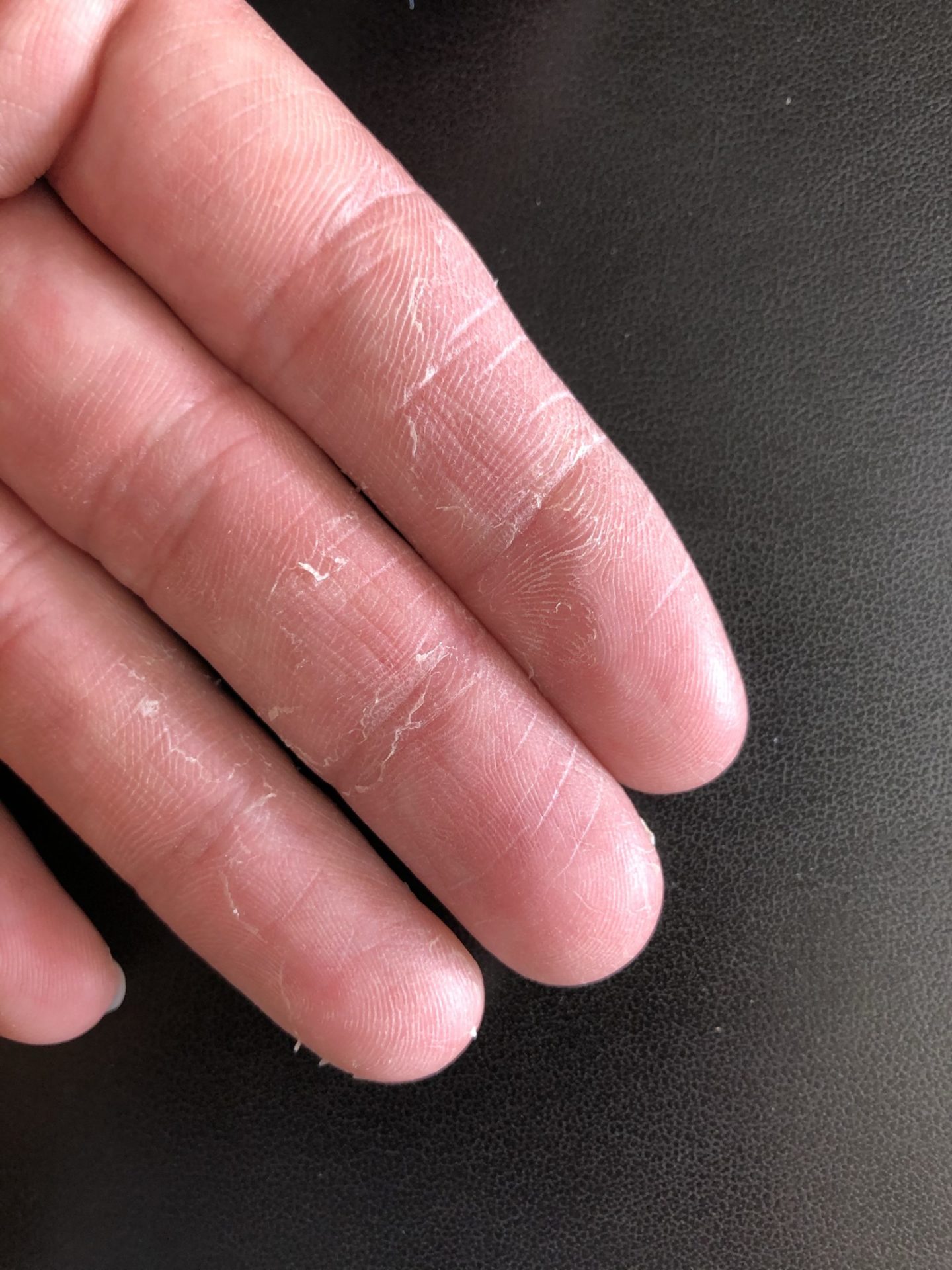 指の皮がむける原因と治し方｜かゆくない・痛い・水ぶくれの見分け方