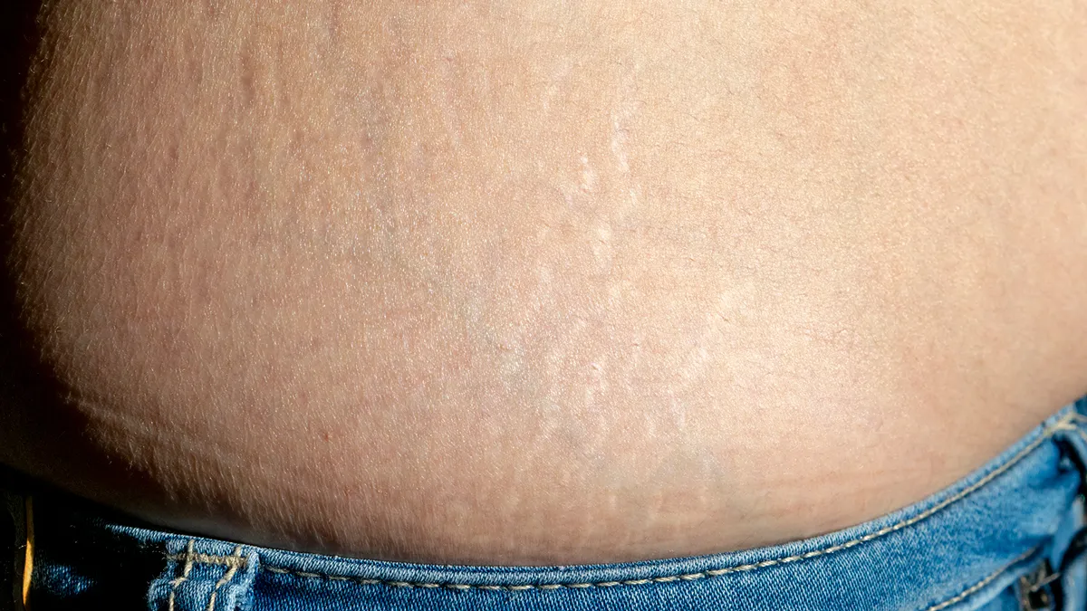 太ももやお尻の肉割れとは？消えない噂の真相と原因・最新治療を追う