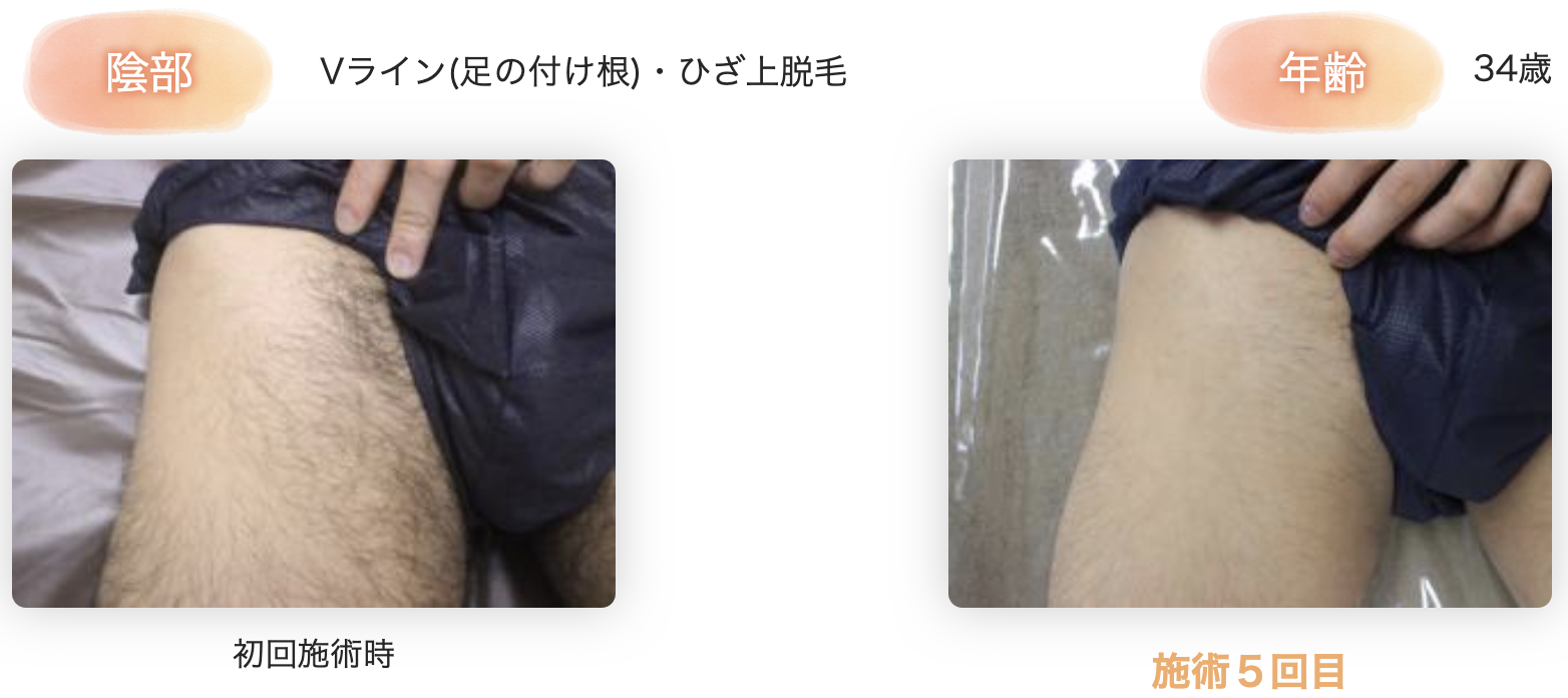 チン毛処理で後悔しない全知識｜チクチク・かゆみを防ぐ正しい整え方