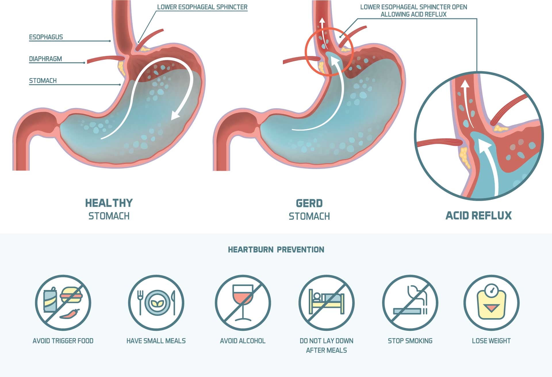 Does Soda Make Acid Reflux Worse