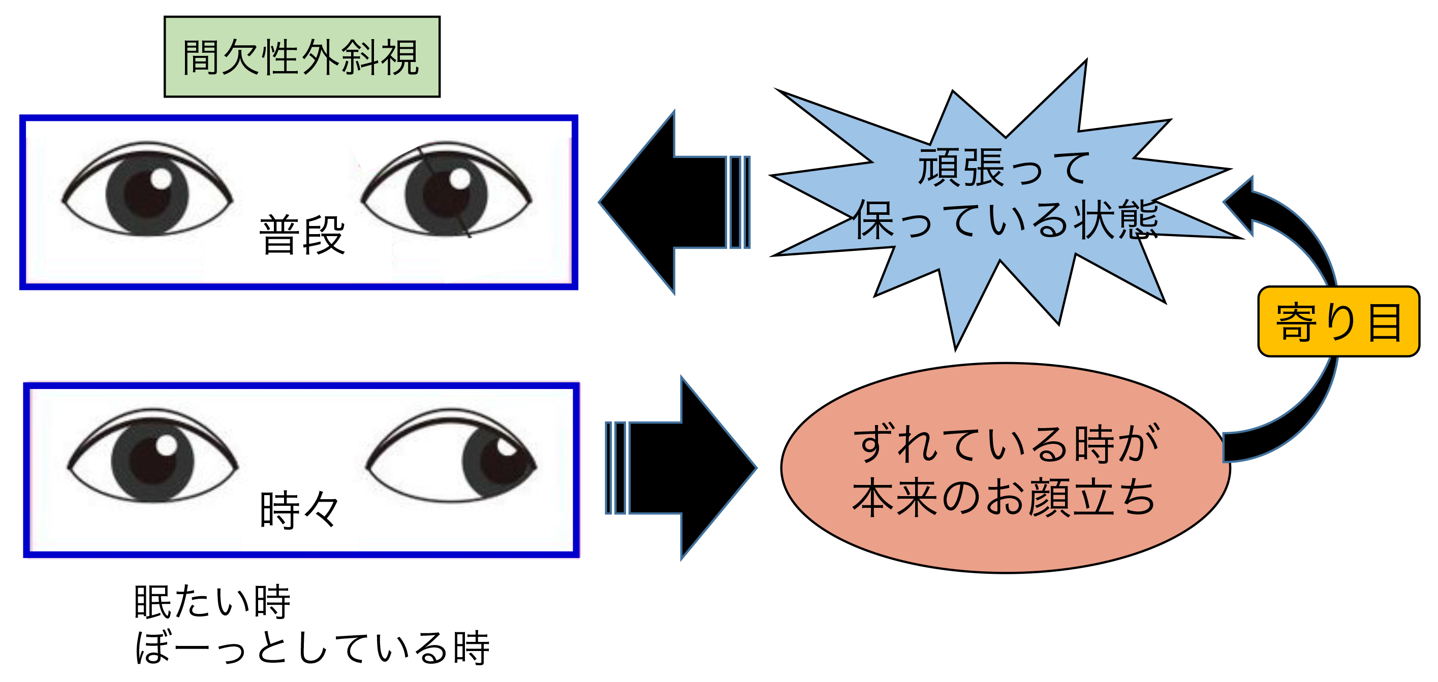 間欠性外斜視の放置リスクとは？原因から手術費用・再発率まで徹底解説