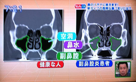 【真相】 好 酸 球 性 副 鼻腔 炎 芸能人 最新ニュース速報 2026 #937